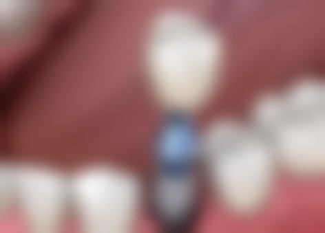 浙江温州乐清夏海勇口腔价格表（仅供参考）