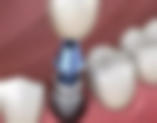 济南市口腔医院口腔种植诊疗中 心医生团队解析